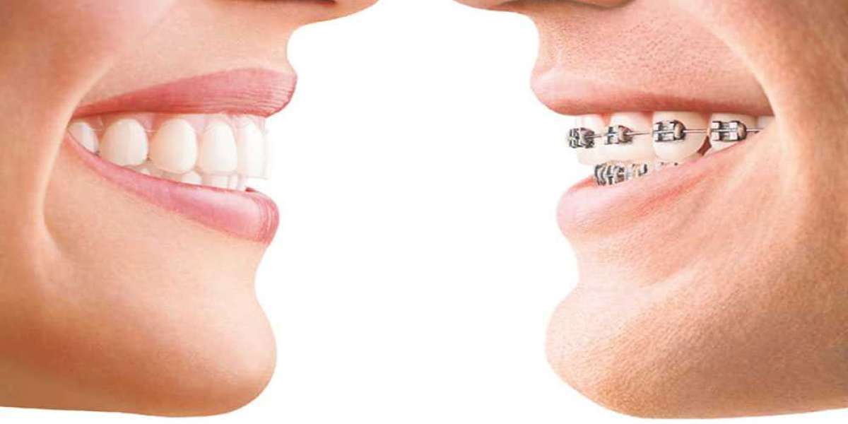 Invisalign vs. Clear Aligners: Understanding Your Options (Amma Naana Dental Clinic)