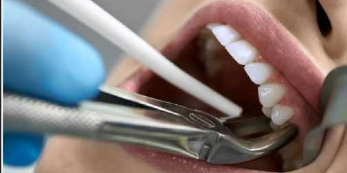 Dental Extractions: A Comprehensive Guide